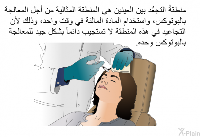 منطقةُ التجعُّد بين العينين هي المنطقة المثالية من أجل المعالجة بالبوتوكس، واستخدام المادة المالئة في وقت واحد، وذلك لأن التجاعيد في هذه المنطقة لا تستجيب دائماً بشكل جيد للمعالجة بالبوتوكس وحده.