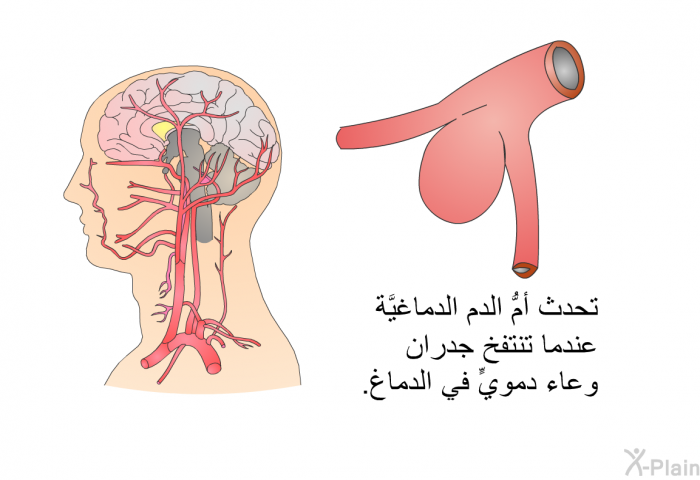تحدث أمُّ الدم الدماغيَّة عندما تنتفخ جدران وعاء دمويٍّ في الدماغ.