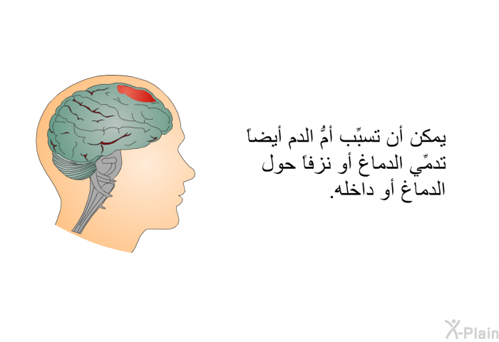 يمكن أن تسبِّب أمُّ الدم أيضاً تدمِّي الدماغ أو نزفاً حول الدماغ أو داخله.