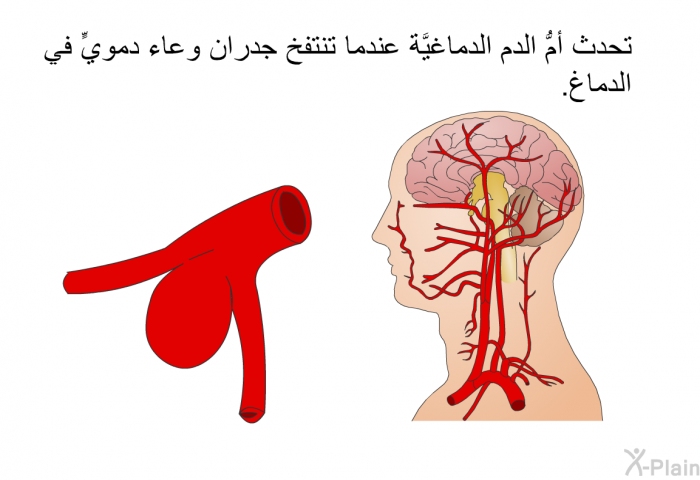 تحدث أمُّ الدم الدماغيَّة عندما تنتفخ جدران وعاء دمويٍّ في الدماغ.