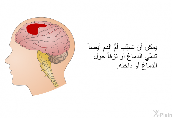 يمكن أن تسبِّب أمُّ الدم أيضاً تدمِّي الدماغ أو نزفاً حول الدماغ أو داخله.