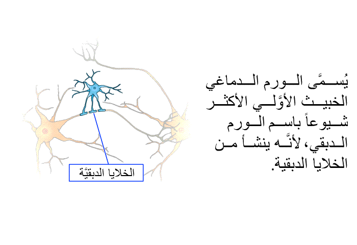 يُسمَّى الورم الدماغي الخبيث الأوَّلي الأكثر شيوعاً باسم الورم الدبقي، لأنَّه ينشأ من الخلايا الدبقية.