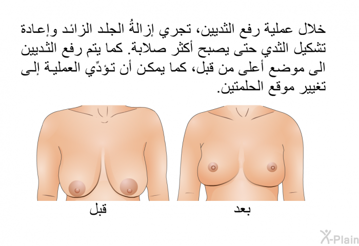 خلال عملية رفع الثديين، تجري إزالةُ الجلد الزائد وإعادة تشكيل الثدي حتى يصبح أكثر صلابة. كما يتم رفع الثديين الى موضع أعلى من قبل، كما يمكن أن تؤدِّي العملية إلى تغيير موقع الحلمتين.