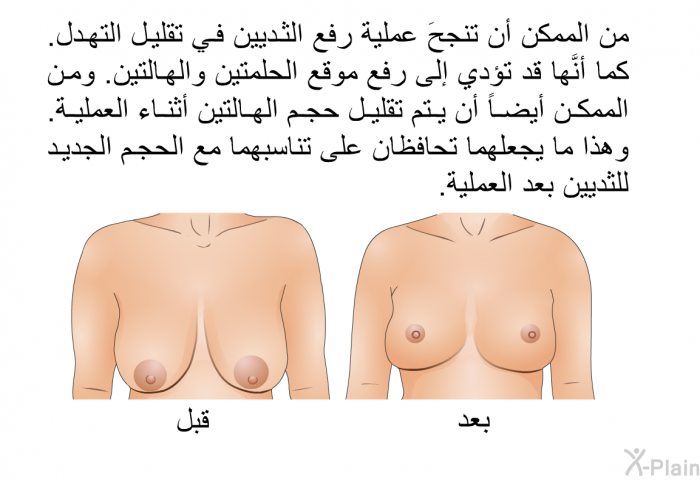 من الممكن أن تنجحَ عملية رفع الثديين في تقليل التهدل. كما أنَّها قد تؤدي إلى رفع موقع الحلمتين والهالتين. ومن الممكن أيضاً أن يتم تقليل حجم الهالتين أثناء العملية. وهذا ما يجعلهما تحافظان على تناسبهما مع الحجم الجديد للثديين بعد العملية.