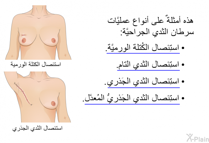هذه أمثلةٌ على أنواع عمليَّات سرطان الثدي الجراحيَّة:  استِئصال الكُتلة الورميَّة. استِئصال الثدي التام. استِئصال الثدي الجَذري. استِئصال الثدي الجَذريُّ المُعدَّل.