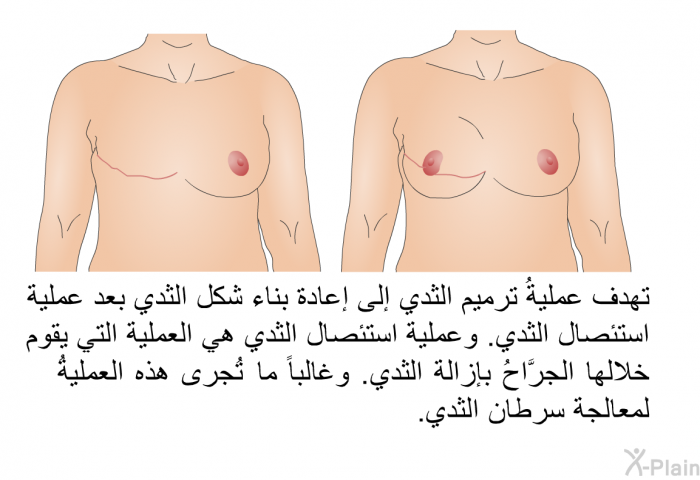 تهدف عمليةُ ترميم الثدي إلى إعادة بناء شكل الثدي بعد عملية استئصال الثدي. وعملية استئصال الثدي هي العملية التي يقوم خلالها الجرَّاحُ بإزالة الثدي. وغالباً ما تُجرى هذه العمليةُ لمعالجة سرطان الثدي.