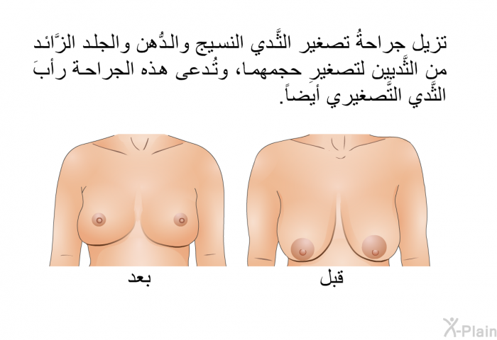 تزيل جراحةُ تصغير الثَّدي النسيجِ والدُّهن والجلد الزَّائد من الثَّديين لتصغيرِ حجمهما، وتُدعى هذه الجراحة رأبَ الثَّدي التَّصغيري أيضاً.