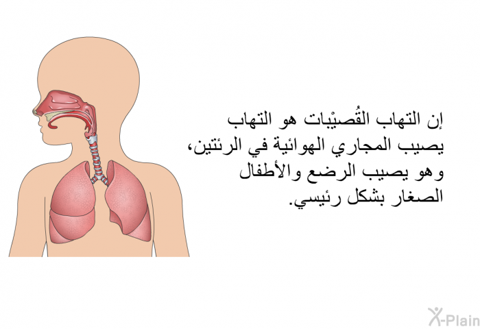 إن التهاب القُصيْبات هو التهاب يصيب المجاري الهوائية في الرئتين، وهو يصيب الرضع والأطفال الصغار بشكل رئيسي.