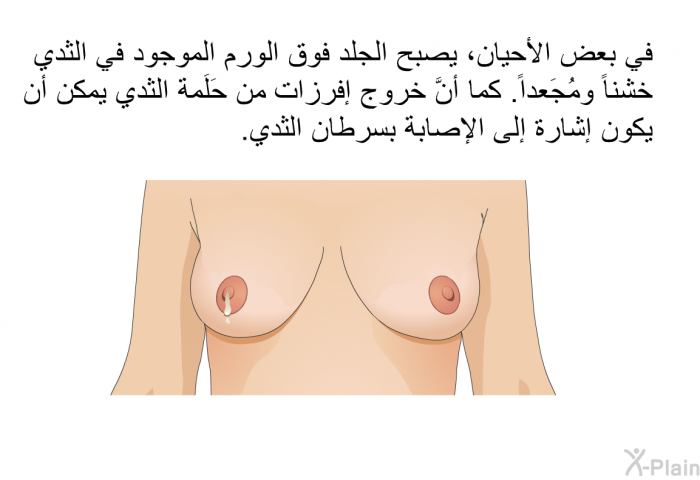 في بعض الأحيان، يصبح الجلد فوق الورم الموجود في الثدي خشناً ومُجَعداً. كما أنَّ خروج إفرزات من حَلَمة الثدي يمكن أن يكون إشارة إلى الإصابة بسرطان الثدي.