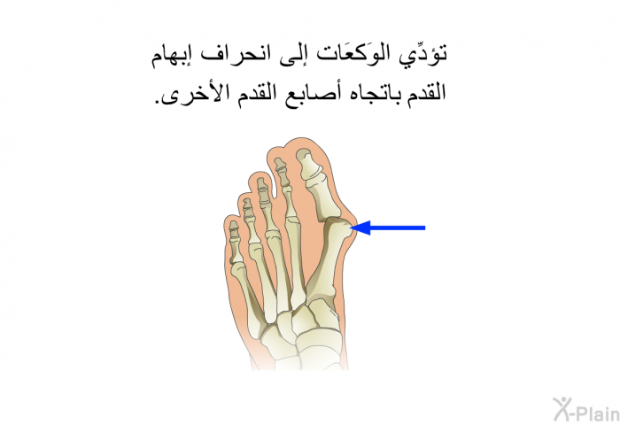 تؤدِّي الوَكعَات إلى انحراف إبهام القدم باتجاه أصابع القدم الأخرى.