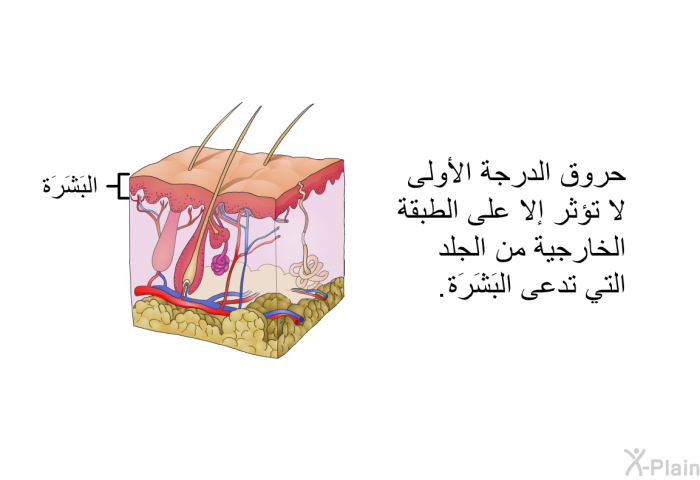 حروق الدرجة الأولى لا تؤثر إلا على الطبقة الخارجية من الجلد التي تدعى البَشَرَة<B>.</B>