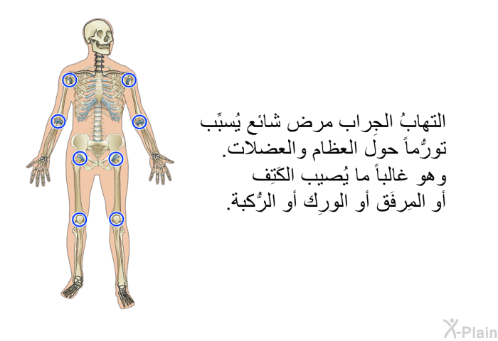 التهابُ الجِراب مرض شائع يُسبِّب تورُّماً حول العظام والعضلات. وهو غالباً ما يُصيب الكَتِف أو المِرفَق أو الوَرِك أو الرُّكبة.