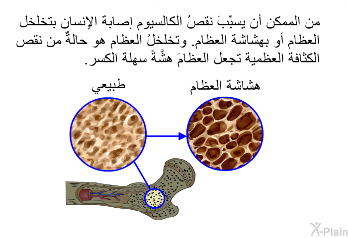 من الممكن أن يسبِّبَ نقصُ الكالسيوم إصابة الإنسان بتخلخل العظام أو بهشاشة العظام. وتخلخلُ العظام هو حالةٌ من نقص الكثافة العظمية تجعل العظامَ هشَّةً سهلةَ الكسر.