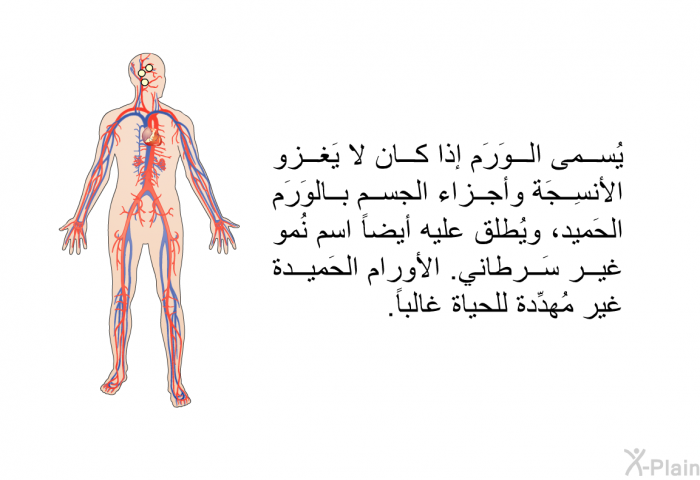 يُسمى الوَرَم إذا كان لا يَغزو الأنسِجَة وأجزاء الجسم بالوَرَم الحَميد، ويُطلق عليه أيضاً اسم نُمو غير سَرطاني. الأورام الحَميدة غير مُهدِّدة للحياة غالباً.