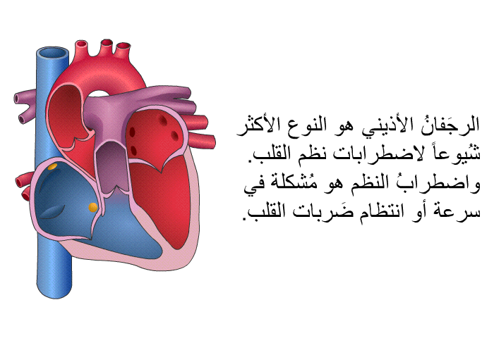 الرجَفانُ الأذيني هو النوع الأكثر شُيوعاً لاضطرابات نظم القلب. واضطرابُ النظم هو مُشكلة في سرعة أو انتظام ضَربات القلب.