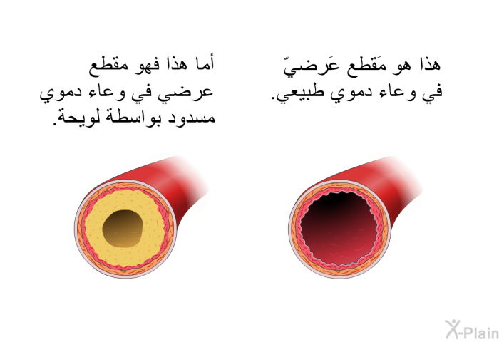 هذا هو مَقطع عَرضيّ في وعاء دموي طبيعي. أما هذا فهو مقطع عرضي في وعاء دموي مسدود بواسطة لويحة.