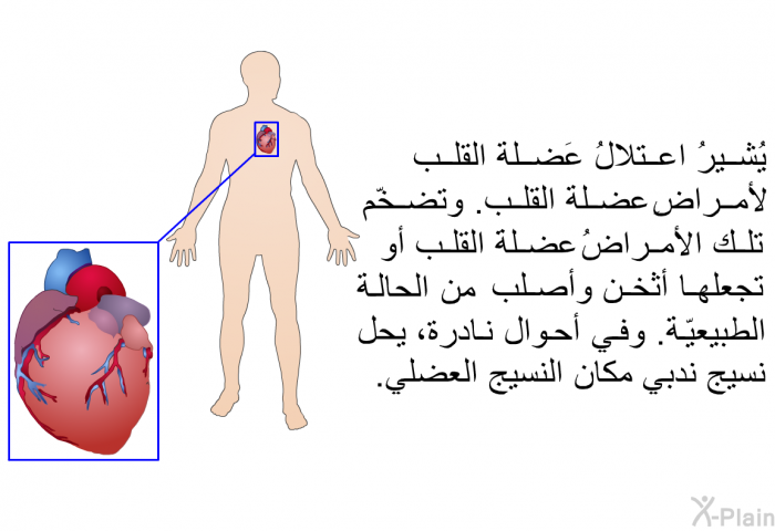 يُشيرُ اعتلالُ عَضلة القلب لأمراضِ عضلة القلب. وتضخّم تلك الأمراضُ عضلةَ القلب أو تجعلها أثخن وأصلب من الحالة الطبيعيّة. وفي أحوال نادرة، يحل نسيج ندبي مكان النسيج العضلي.