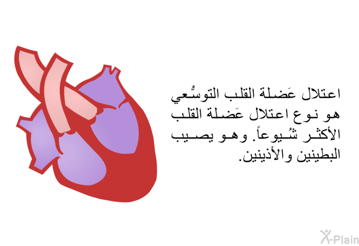 اعتلال عَضلة القلب التوسُّعي هو نوع اعتلال عَضلة القلب الأكثر شُيوعاً. وهو يصيب البطينين والأذينين.