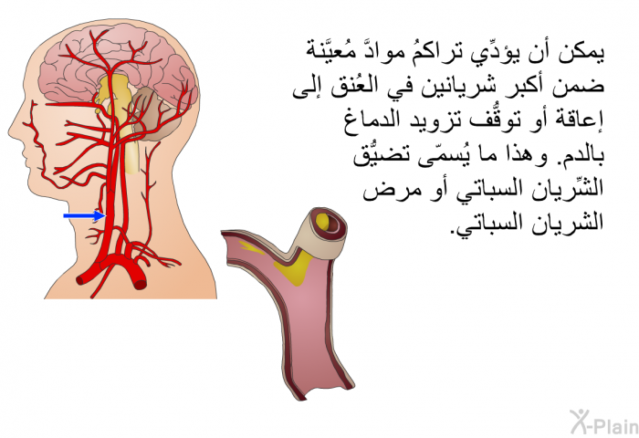 يمكن أن يؤدِّي تراكمُ موادَّ مُعيَّنة ضمن أكبر شريانين في العُنق إلى إعاقة أو توقُّف تزويد الدماغ بالدم. وهذا ما يُسمّى تضيُّق الشِّريان السباتي أو مرض الشريان السباتي.