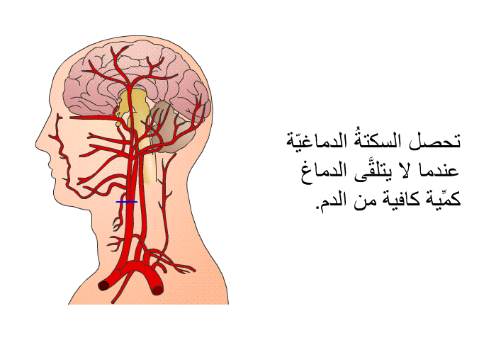 تحصل السكتةُ الدماغيّة عندما لا يتلقَّى الدماغ كمِّية كافية من الدم.