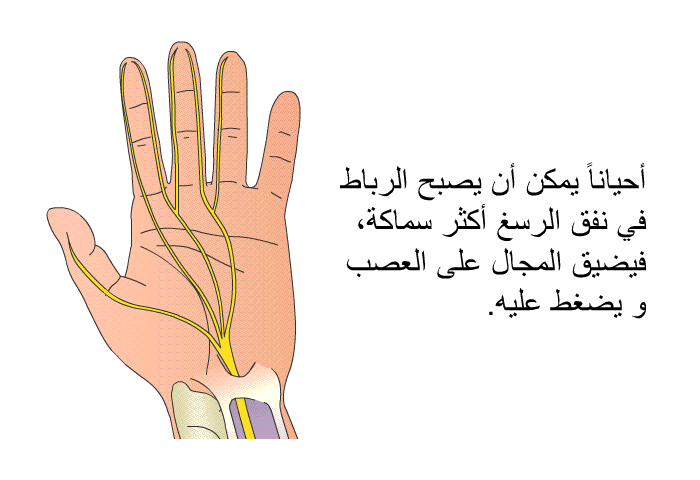 أحياناً يمكن أن يصبح الرباط في نفق الرسغ أكثر سماكة، فيضيق المجال على العصب و يضغط عليه<B>. </B>