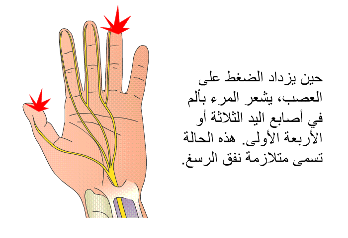 حين يزداد الضغط على العصب، يشعر المرء بألم في أصابع اليد الثلاثة أو الأربعة الأولى<B>. </B>هذه الحالة تسمى متلازمة نفق الرسغ<B>. </B>