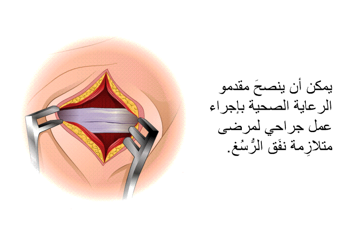 يمكن أن ينصحَ مقدمو الرعاية الصحية بإجراء عمل جراحي لمرضى متلازِمة نفَق الرُّسُغ.