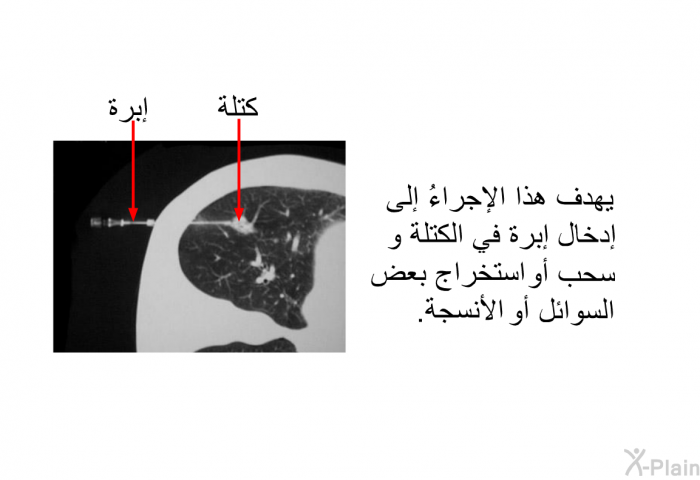 يهدف هذا الإجراءُ إلى إدخال إبرة في الكتلة وسحب أو استخراج بعض السوائل أو الأنسجة.