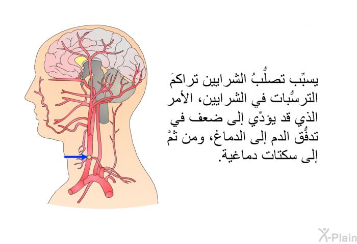 يسبِّب تصلُّبُ الشرايين تراكمَ الترسُّبات في الشرايين، الأمر الذي قد يؤدِّي إلى ضعف في تدفُّق الدم إلى الدماغ، ومن ثمَّ إلى سكتات دماغية.