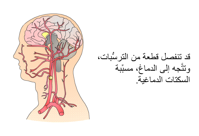 قد تنفصل قطعةٌ من الترسُّبات، وتتَّجه إلى الدماغ، مسبِّبةً السكتات الدماغية.