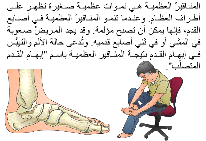 المناقيرُ العظمية هي نموات عظمية صغيرة تظهر على أطراف العظام. وعندما تنمو المناقيرُ العظمية في أصابع القدم، فإنها يمكن أن تصبح مؤلمة. وقد يجد المريضُ صعوبةَ في المشي أو في ثني أصابع قدميه. وتُدعى حالة الألم والتيبُّس في إبهام القدم نتيجة المناقير العظمية باسم "إبهام القدم المتصلِّب".