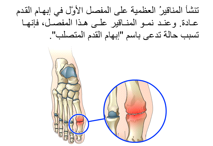 تنشأ المناقيرُ العظمية على المفصل الأوَّل في إبهام القدم عادة. وعند نمو المناقير على هذا المفصل، فإنها تسبب حالة تدعى باسم "إبهام القدم المتصلب".