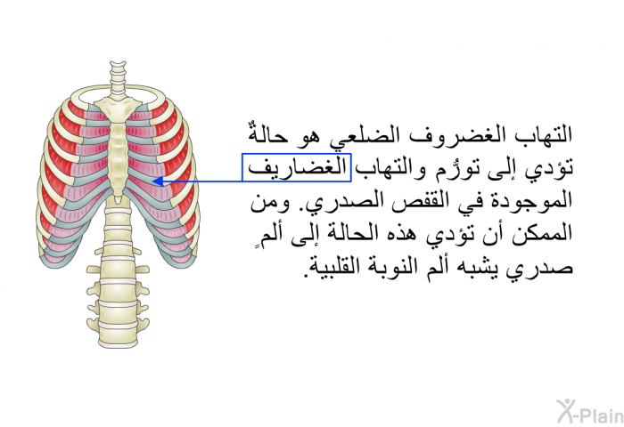 التهاب الغضروف الضلعي هو حالةٌ تؤدي إلى تورُّم والتهاب الغضاريف الموجودة في القفص الصدري. ومن الممكن أن تؤدي هذه الحالة إلى ألمٍ صدري يشبه ألم النوبة القلبية.