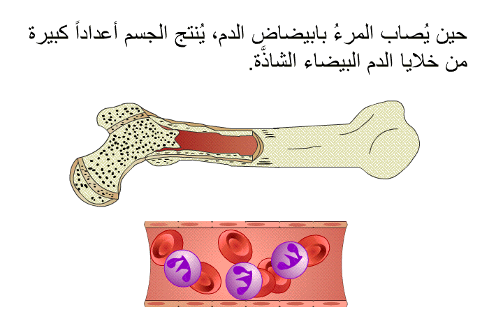حين يُصاب المرءُ بابيضاض الدم، يُنتج الجسم أعداداً كبيرة من خلايا الدم البيضاء الشاذَّة.