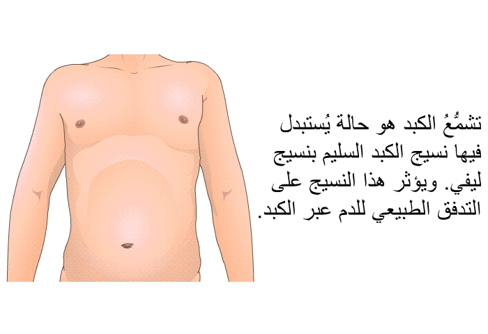 تشمُّعُ الكبد هو حالة يُستبدل فيها نسيج الكبد السليم بنسيج ليفي. ويؤثر هذا النسيج على التدفق الطبيعي للدم عبر الكبد.
