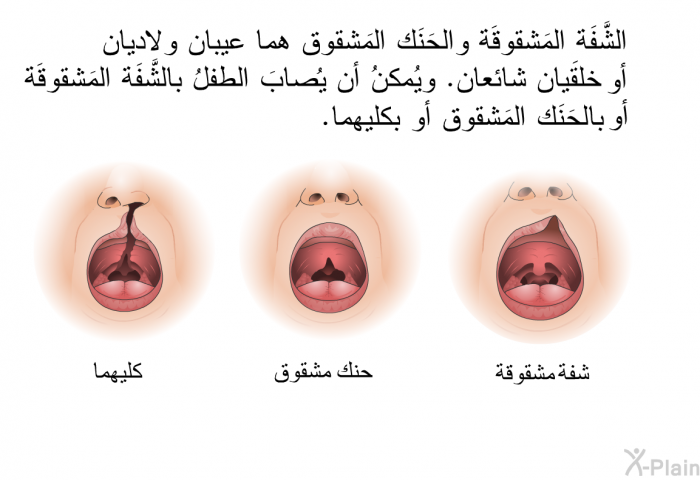 الشَّفَة المَشقوقَة والحَنَك المَشقوق هما عيبان ولاديان أو خِلقيان شائعان. ويُمكنُ أن يُصابَ الطفلُ بالشَّفَة المَشقوقَة أو بالحَنَك المَشقوق أو بكليهما.