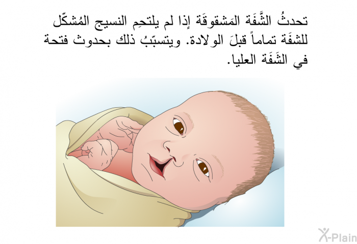 تحدثُ الشَّفَة المَشقوقَة إذا لم يلتحِم النسيج المُشكّل للشفَة تماماً قبلَ الولادة. ويتسبّبُ ذلك بحدوث فتحة في الشَفَة العليا.
