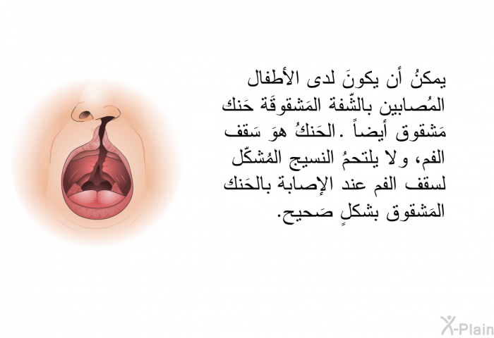 يمكنُ أن يكونَ لدى الأطفال المُصابين بالشّفة المَشقوقَة حَنكمَشقوق أيضاً . الحَنكُ هوَ سَقف الفم، ولا يلتحمُ النسيج المُشكّل لسقف الفم عند الإصابة بالحَنك المَشقوق بشكلٍ صَحيح.