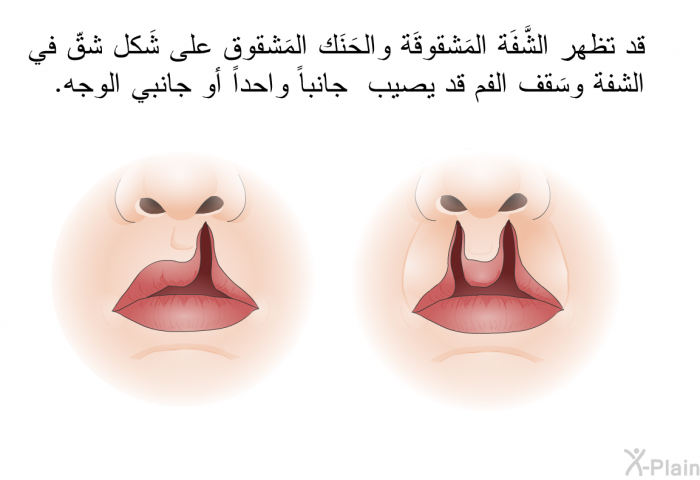 قد تظهر الشَّفَة المَشقوقَة والحَنَك المَشقوق على شَكل شقّ في الشفة وسَقف الفم قد يصيب جانباً واحداً أو جانبي الوجه.