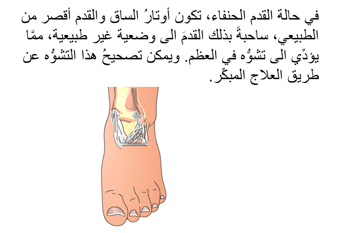 في حالة القدم الحنفاء، تكون أوتارُ الساق والقدم أقصر من الطبيعي، ساحبةً بذلك القدمَ الى وضعية غير طبيعية، ممَّا يؤدِّي الى تشوُّه في العظم. ويمكن تصحيحُ هذا التشوُّه عن طريق العلاج المبكِّر.