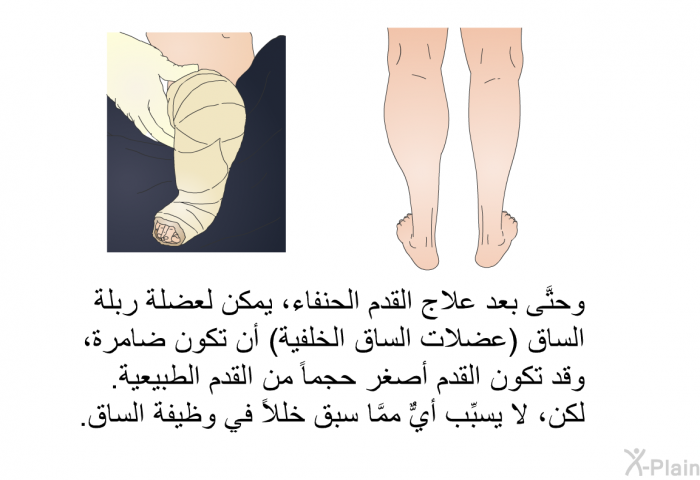 وحتَّى بعد علاج القدم الحنفاء، يمكن لعضلة ربلة الساق (عضلات الساق الخلفية) أن تكون ضامرة، وقد تكون القدم أصغر حجماً من القدم الطبيعية. لكن، لا يسبِّب أيٌّ ممَّا سبق خللاً في وظيفة الساق.
