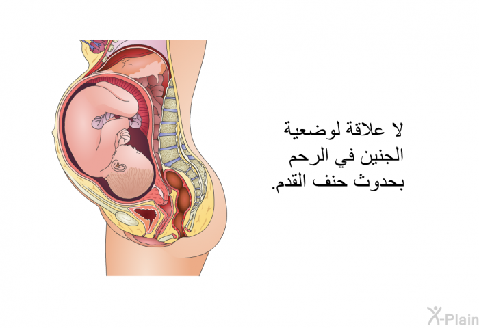 لا علاقة لوضعية الجنين في الرحم بحدوث حنف القدم.