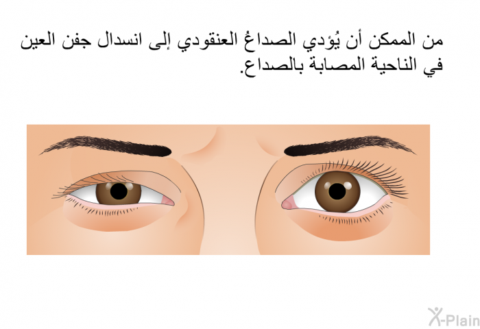 من الممكن أن يُؤدي الصداعُ العنقودي إلى انسدال جفن العين في الناحية المصابة بالصداع.