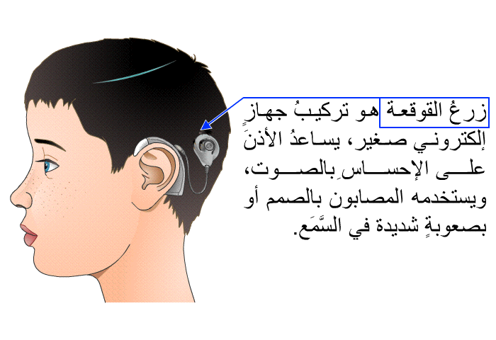 زرعُ القوقعة هو تركيبُ جهازٍ إلكتروني صغير، يساعدُ الأذنَ على الإحساسِ بالصوت، ويستخدمه المصابون بالصمم أو بصعوبةٍ شديدة في السَّمَع.