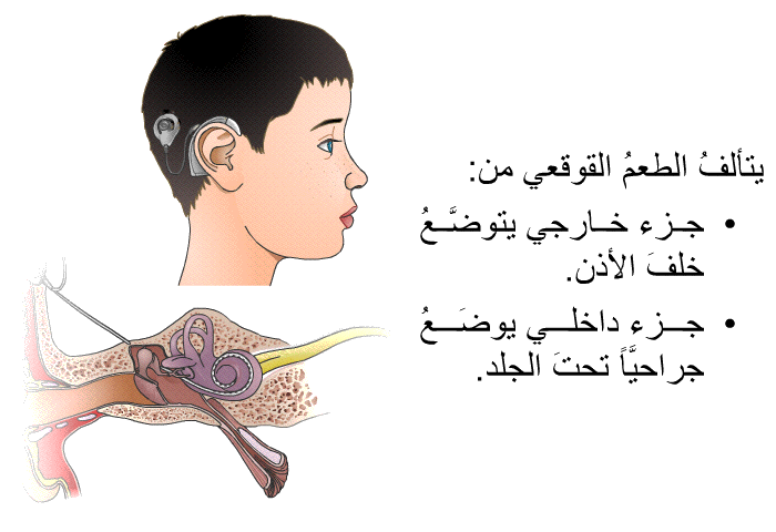 يتألفُ الطعمُ القوقعي من:   جزء خارجي يتوضَّعُ خلفَ الأذن. جزء داخلي يوضَعُ جراحيَّاً تحتَ الجلد.