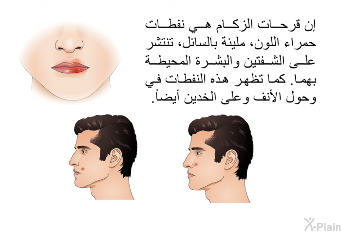 إن قرحات الزكام هي نفطات حمراء اللون، مليئة بالسائل، تنتشر على الشفتين والبشرة المحيطة بهما. كما تظهر هذه النفطات في وحول الأنف وعلى الخدين أيضاَ.