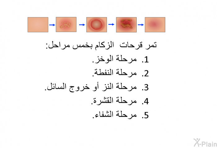 تمر قرحات الزكام بخمس مراحل:  مرحلة الوخز. مرحلة النفطة. مرحلة النز أو خروج السائل. مرحلة القشرة. مرحلة الشفاء.