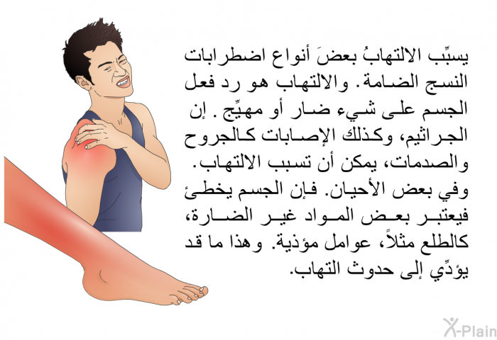 يسبِّب الالتهابُ بعضَ أنواع اضطرابات النسج الضامة. والالتهاب هو رد فعل الجسم على شيء ضار أو مهيِّج. إن الجراثيم، وكذلك الإصابات كالجروح والصدمات، يمكن أن تسبب الالتهاب. وفي بعض الأحيان. فإن الجسم يخطئ فيعتبر بعض المواد غير الضارة، كالطلع مثلاً، عوامل مؤذية. وهذا ما قد يؤدِّي إلى حدوث التهاب.