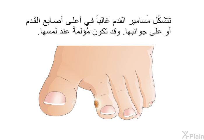 تتشكَّل مَسامير القدم غالباً في أعلى أصابع القدم أو على جوانبها. وقد تكون مُؤلمةً عند لمسها.