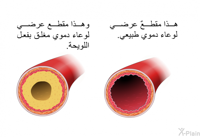 وهذا مقطعٌ عرضي لوعاء دموي طبيعي. وهذا مقطع عرضي لوعاء دموي مغلق بفعل اللويحة.